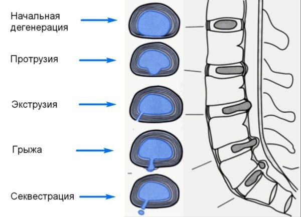 Грыжи и протрузии