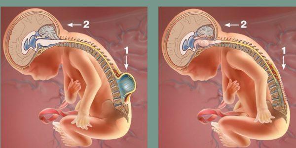 Пренатальное лечение Spina bifida