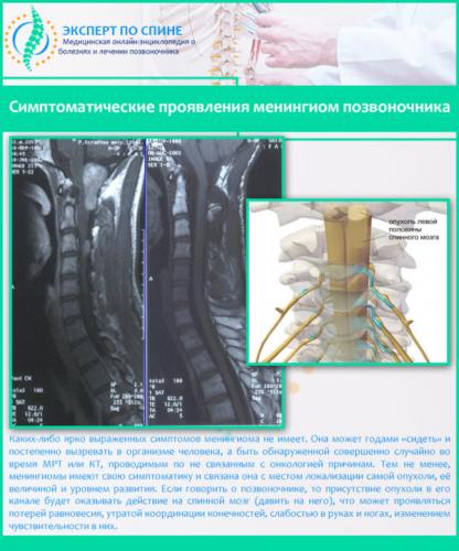 Симптоматические проявления менингиом позвоночника