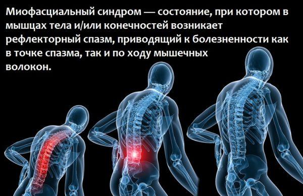 Миофасциальный синдром