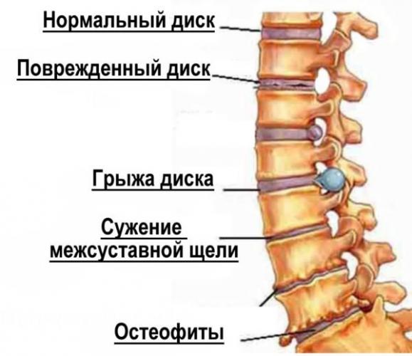 Остеохондроз