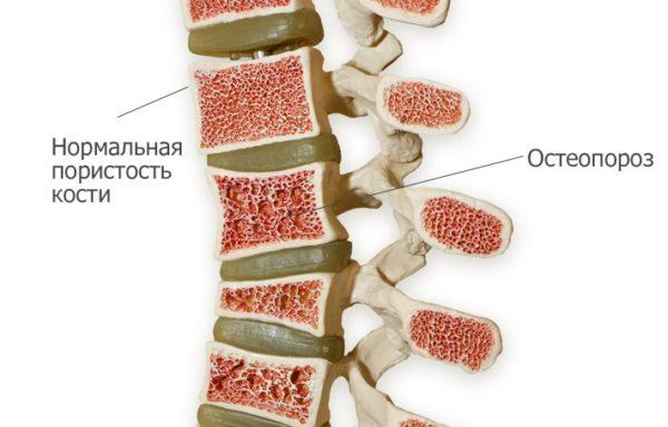 Остеопороз позвоночника