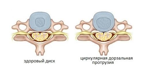 Циркулярная протрузия