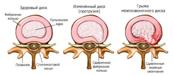 Стадии образования грыжи