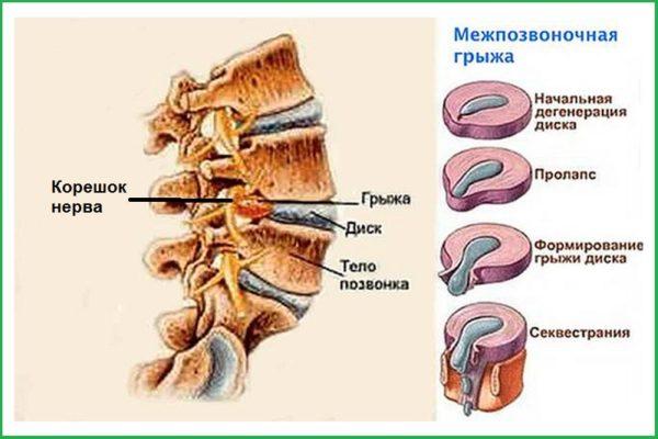 Межпозвоночная грыжа