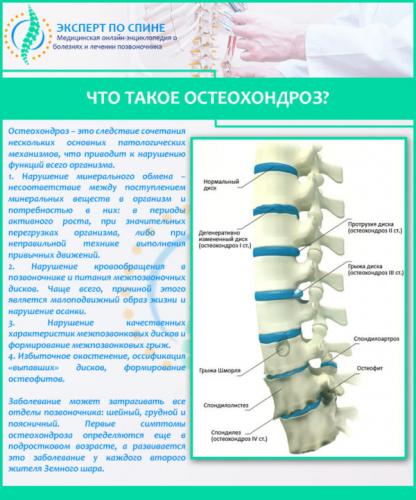 Что такое остеохондроз