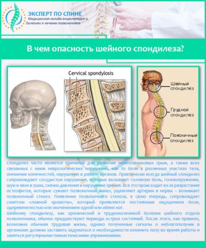 В чем опасность шейного спондилеза