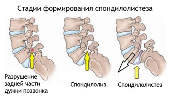 Спондилолистез