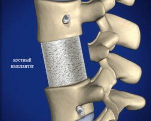 После того, как хирург подготовил пространство, на место удаленного позвонка вводится костный имплантат