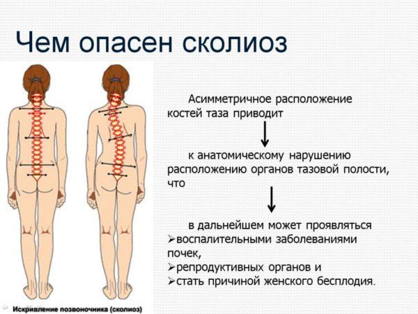 Чем опасен сколиоз