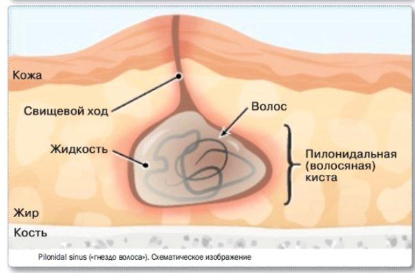 Волосяная киста копчика
