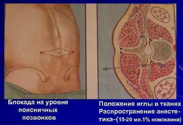 Паравертебральная блокада