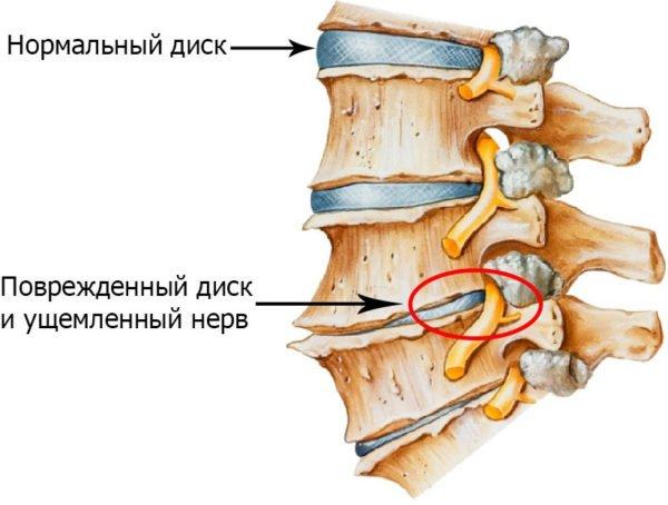 Артроз позвоночника