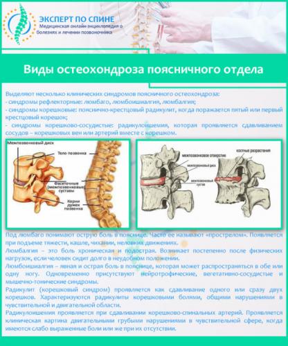 Виды остеохондроза поясничного отдела