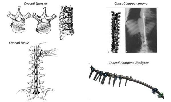 Методы оперативного лечения сколиоза