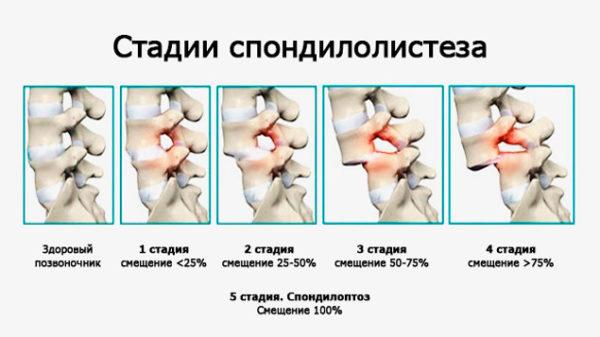 Стадии развития спондилолистеза