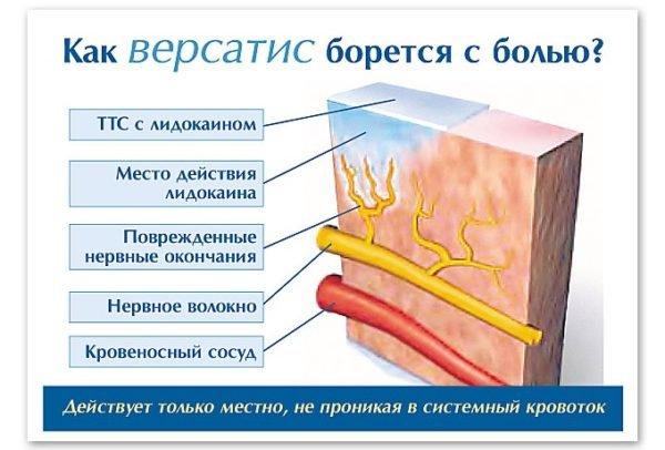 Действие пластыря Версатис 