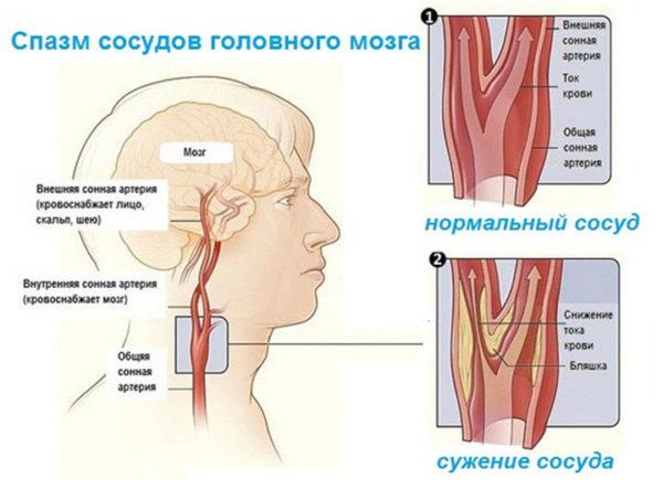 Спазм сосудов головного мозга