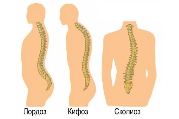 Искривление позвоночника: лордоз, кифоз и сколиоз