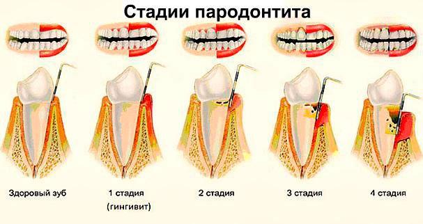 пародонтит