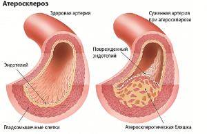 Атеросклероз 