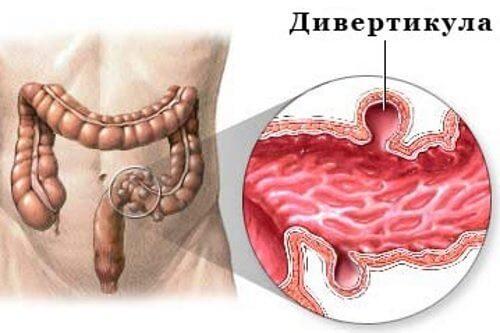Девертикулез