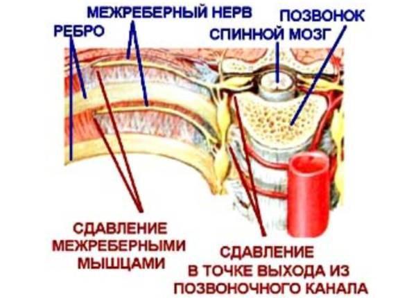 Межреберная невралгия