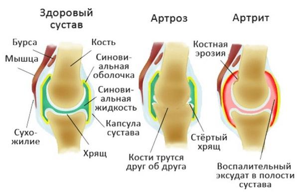 Часто артрит возникает на фоне артроза