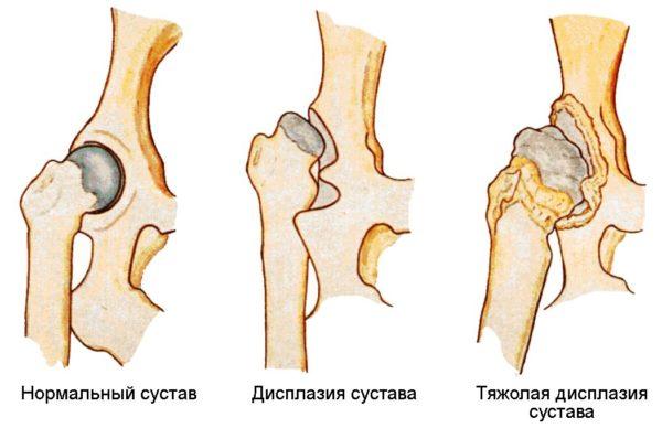 Дисплазия тазобедренных суставов