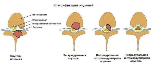 Классификация опухолей