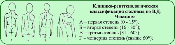 Нервно мышечный сколиоз клинические рекомендации