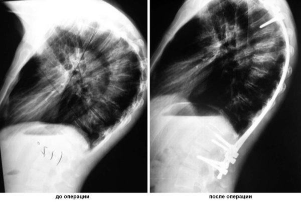 Результат оперативного лечения кифоза