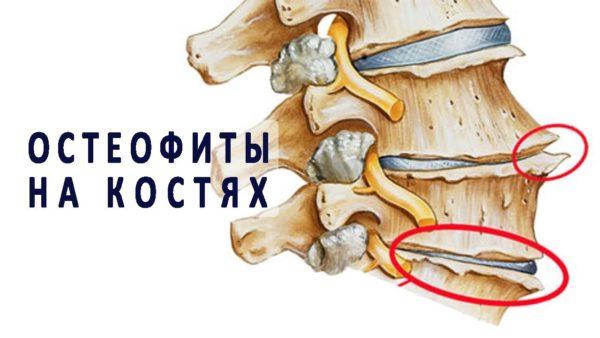 Остеофиты