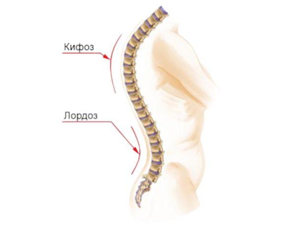 Кифоз и лордоз