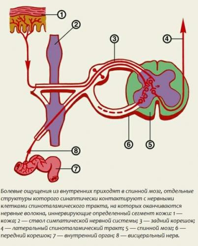 Схема возникновения отраженной боли