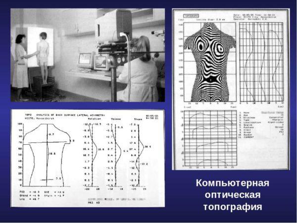 Компьютерная оптическая топография