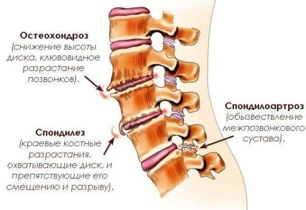 Схематичное изображение спондилеза