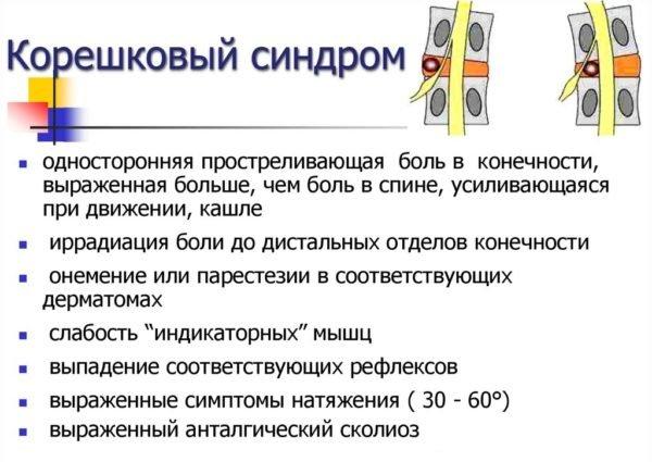 Корешковый синдром