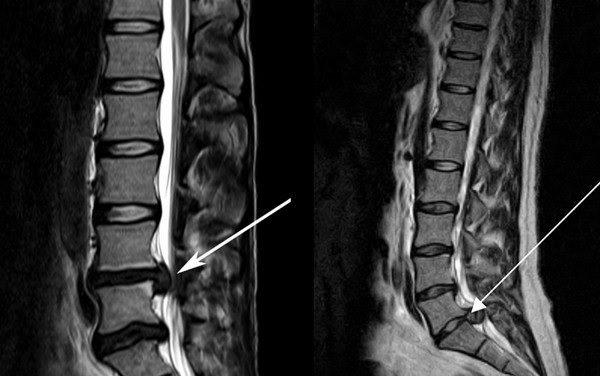 Межпозвонковая грыжа на снимке МРТ