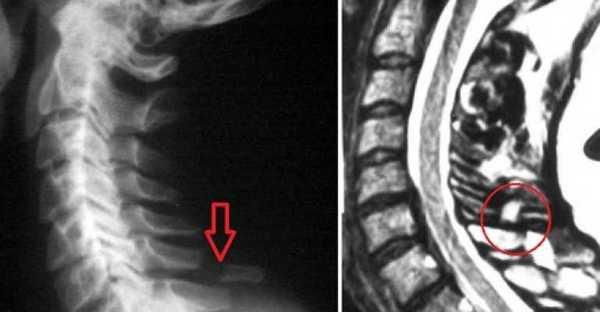 Перелом остистого отростка позвонка может случиться в результате ДТП, падения или резкого закидывания головы