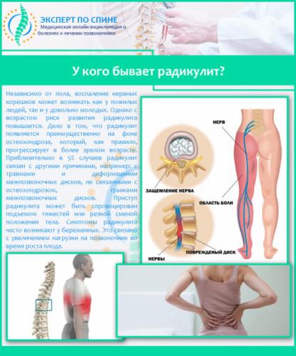 У кого бывает радикулит
