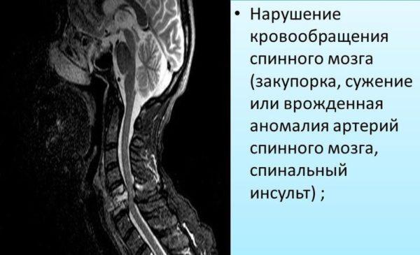 Нарушение кровообращения спинного мозга (закупорка, сужение или врожденная аномалия артерий спинного мозга, спинальный инсульт)