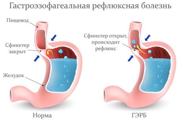 Гастроэзофагеальная рефлюксная болезнь (ГЭРБ)