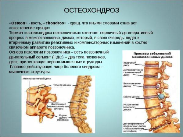 Osteochondrosis