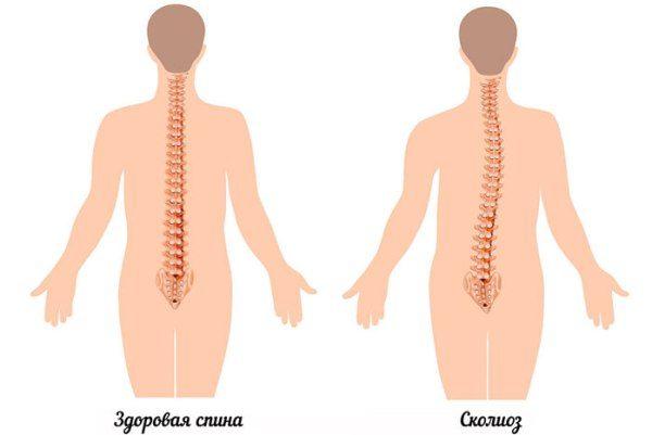 Деформирование позвоночного столба без лечения усиливается и приводит к нарушению функционирования внутренних органов