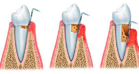 пародонтоз