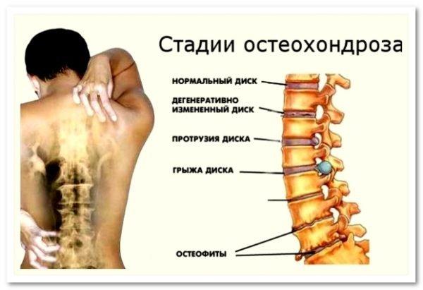 4 стадии остеохондроза