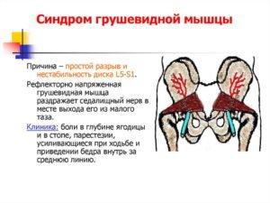 Синдром грушевидной мышцы