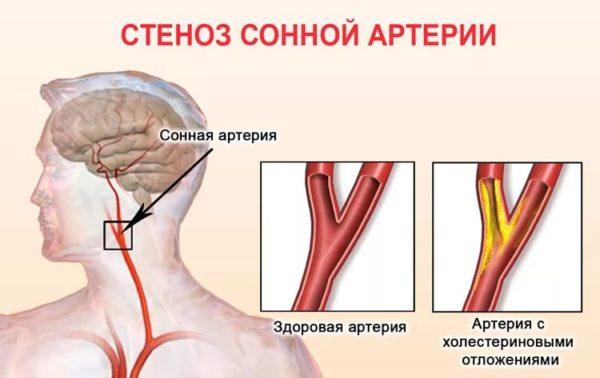 Стеноз сонной артерии