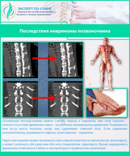 Последствия невриномы позвоночника